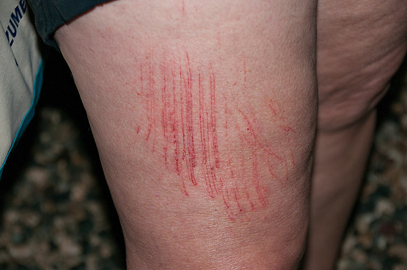 Jellyfish sting on Cheryl's leg